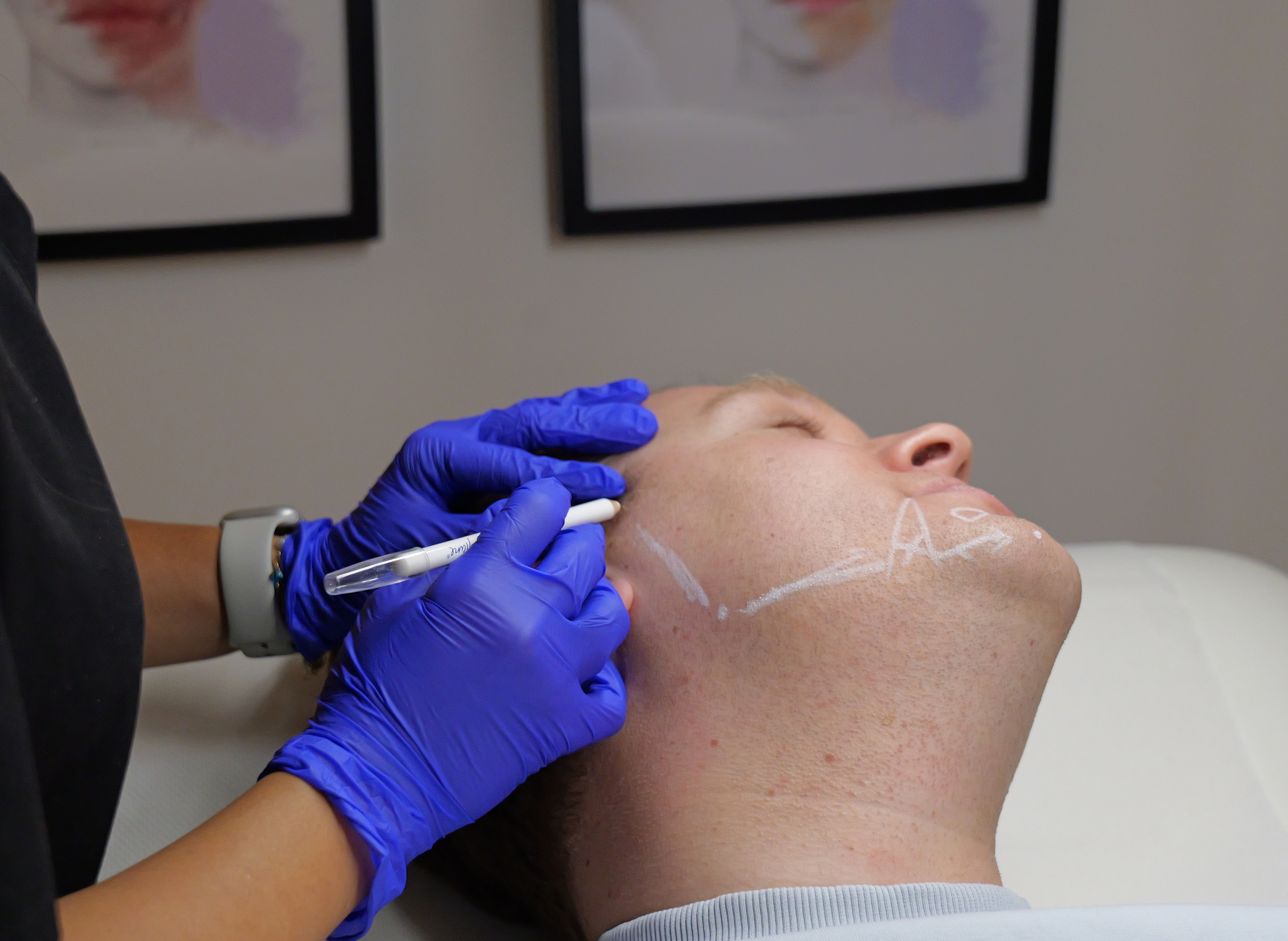 dermal fillers drc treats patient two