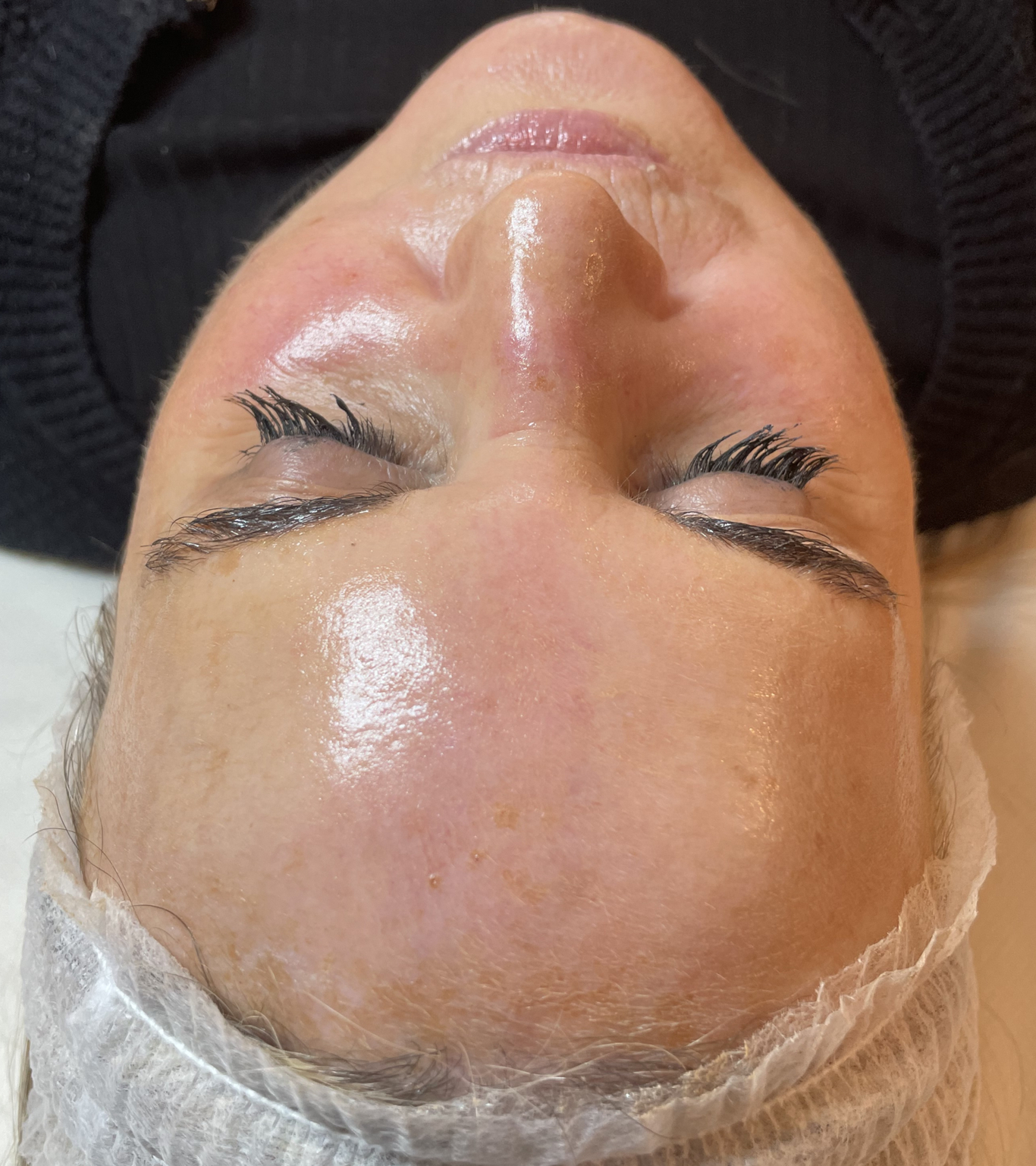 chemical peel after face