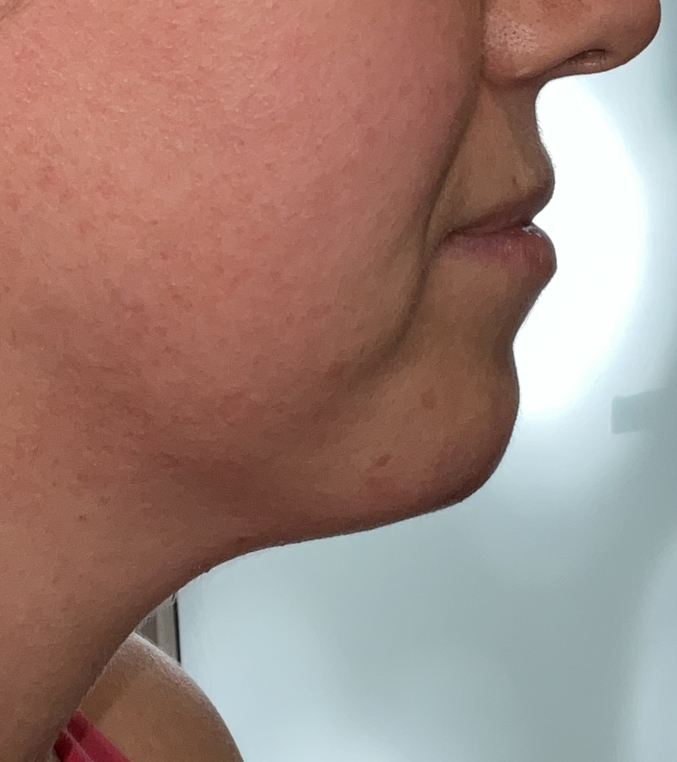 chin filler after right profile