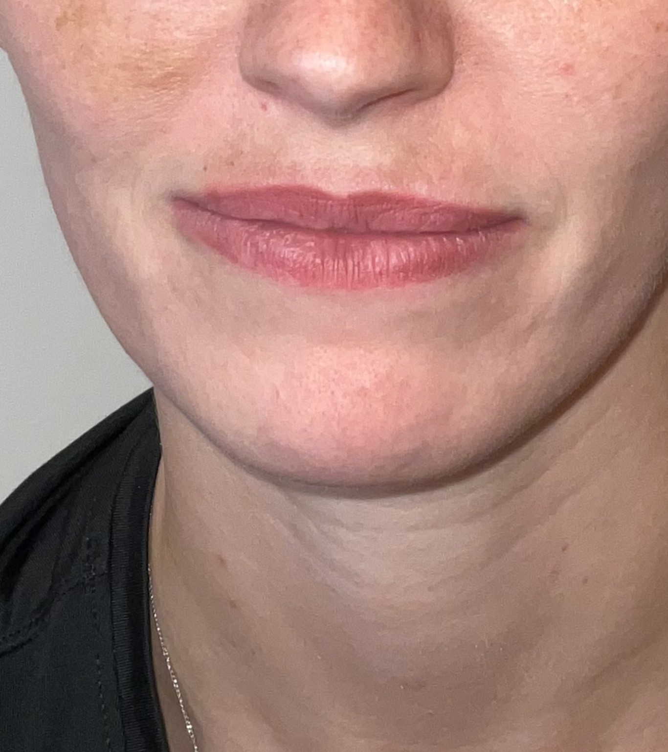 lip dissolving after