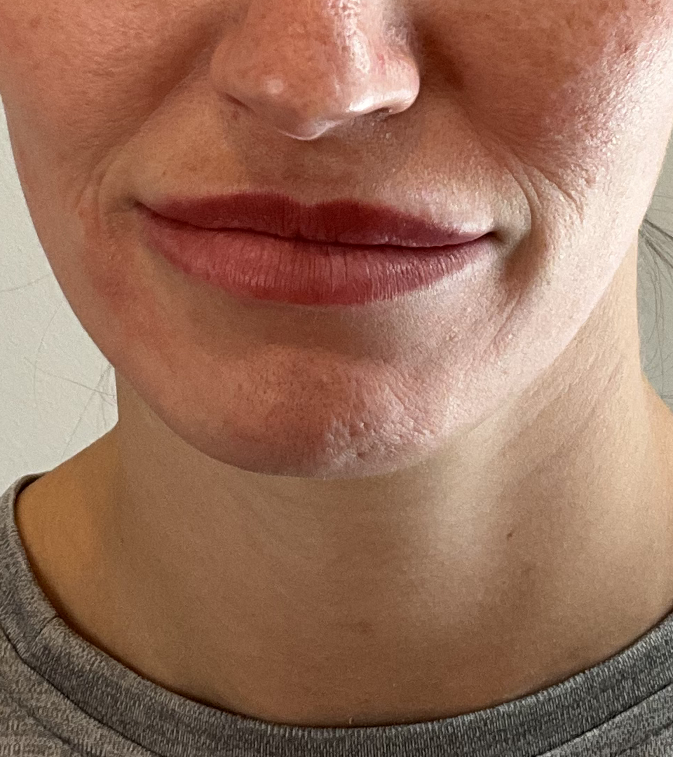 lip dissolving before