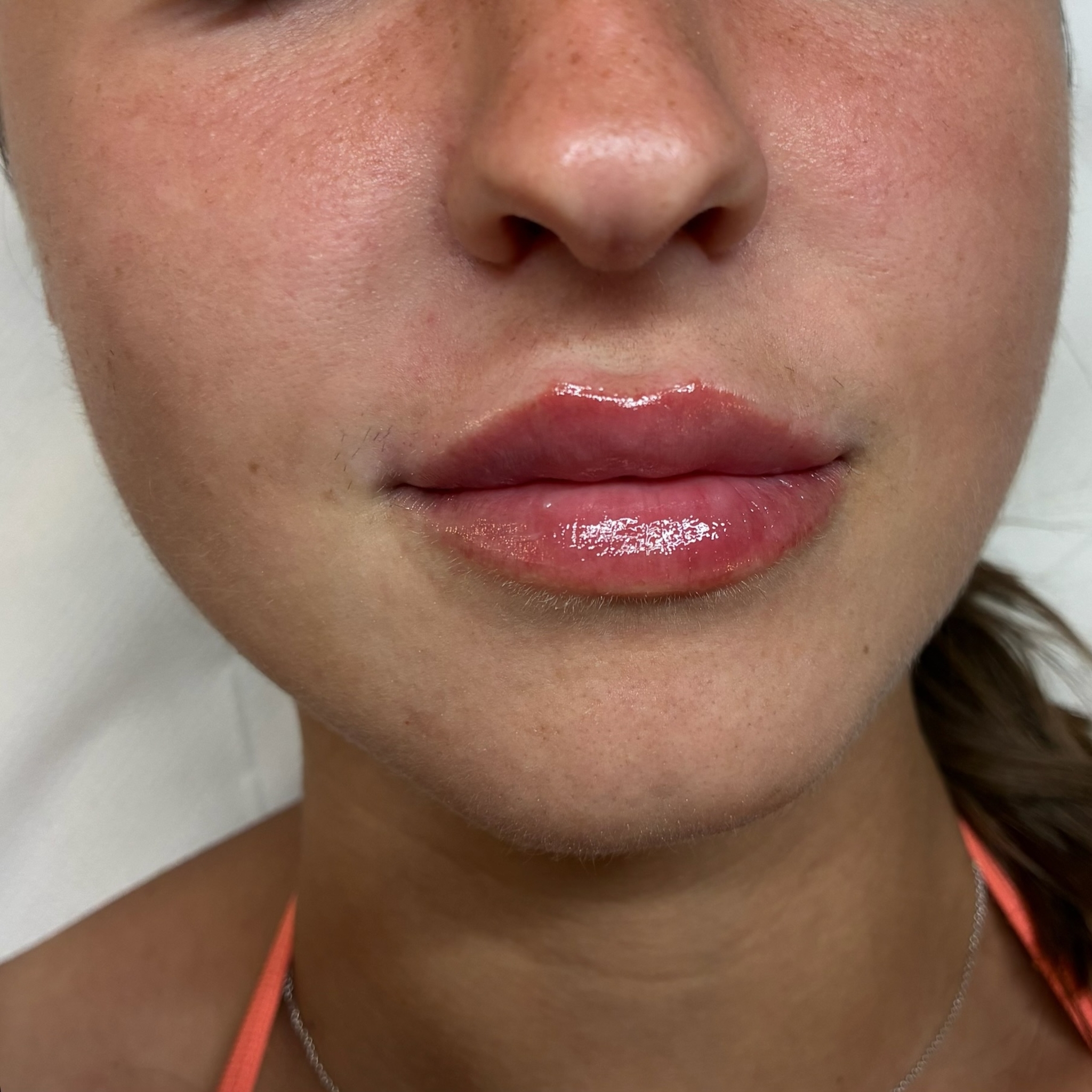 lips eight front after