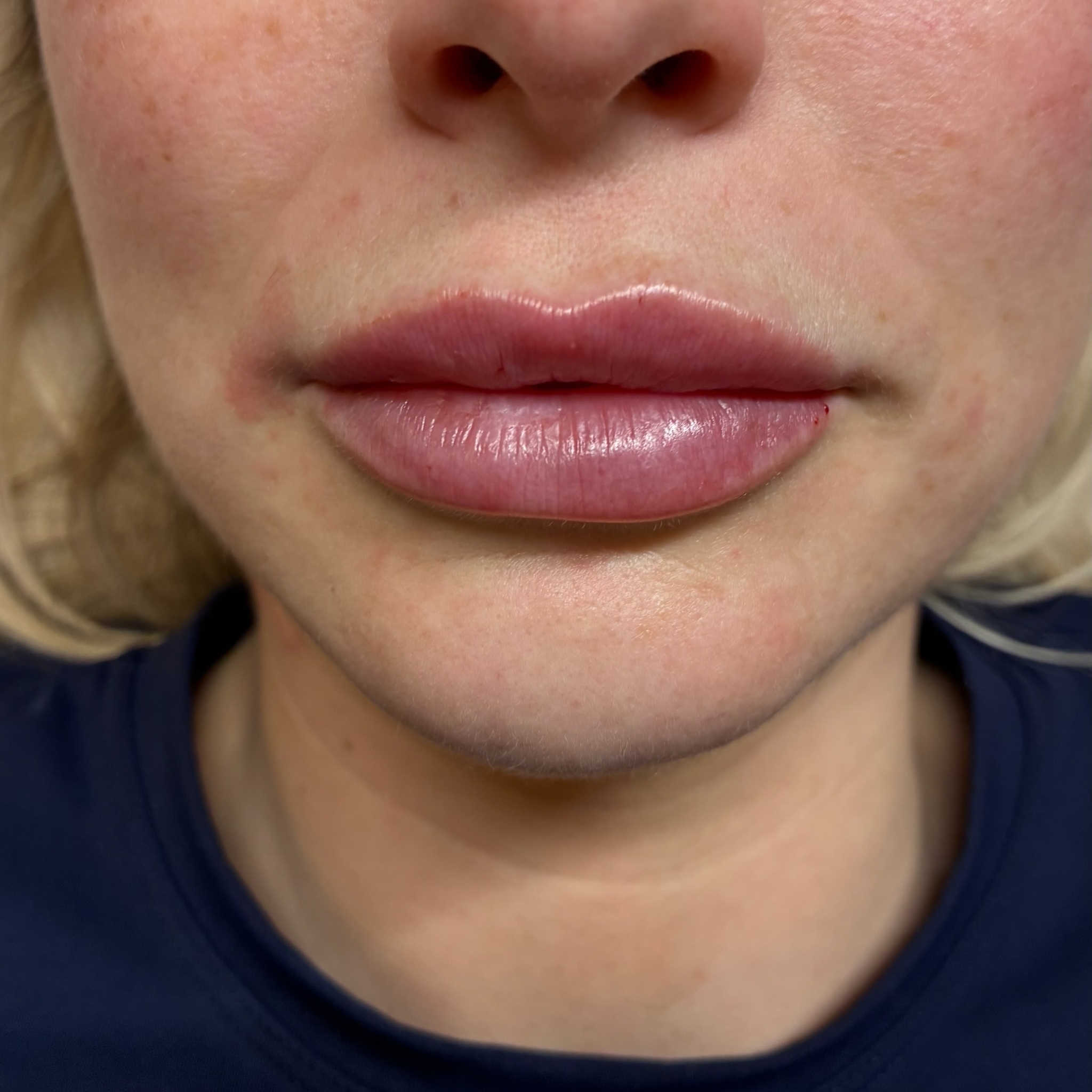 lips five front after