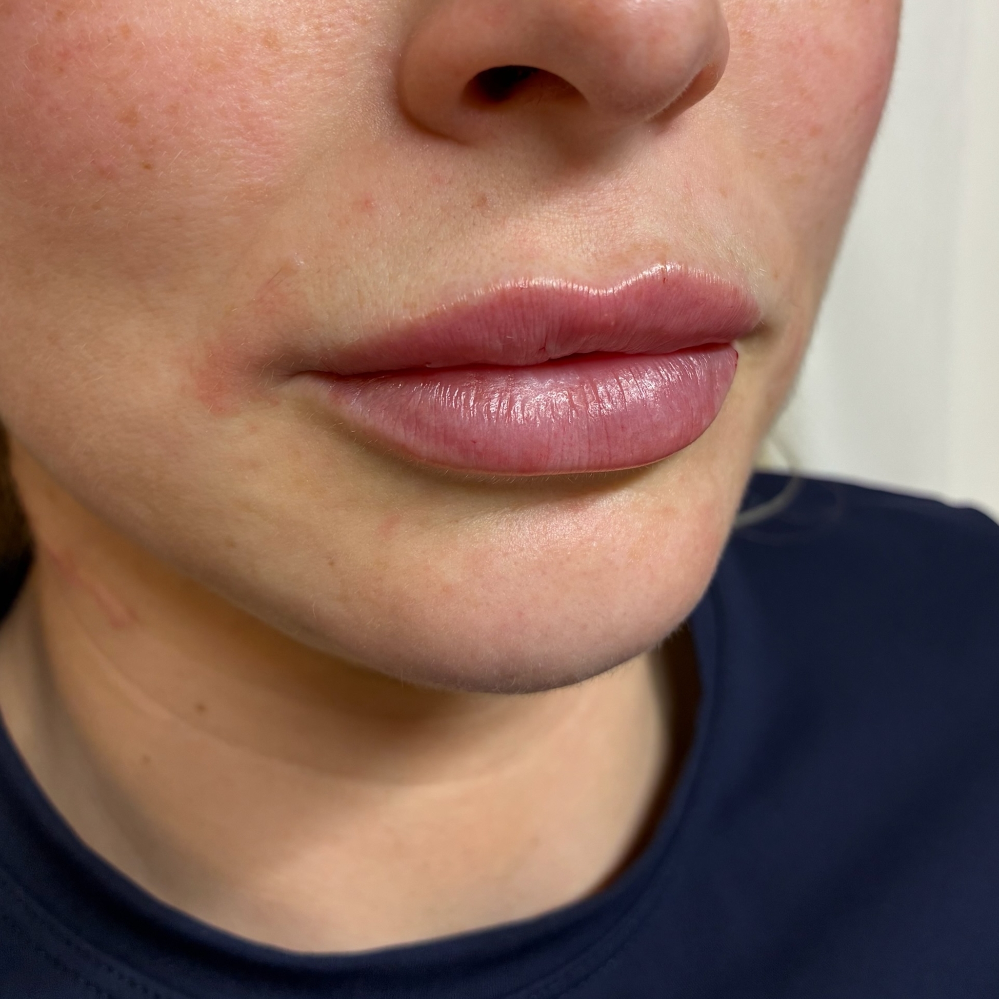 lips five right after