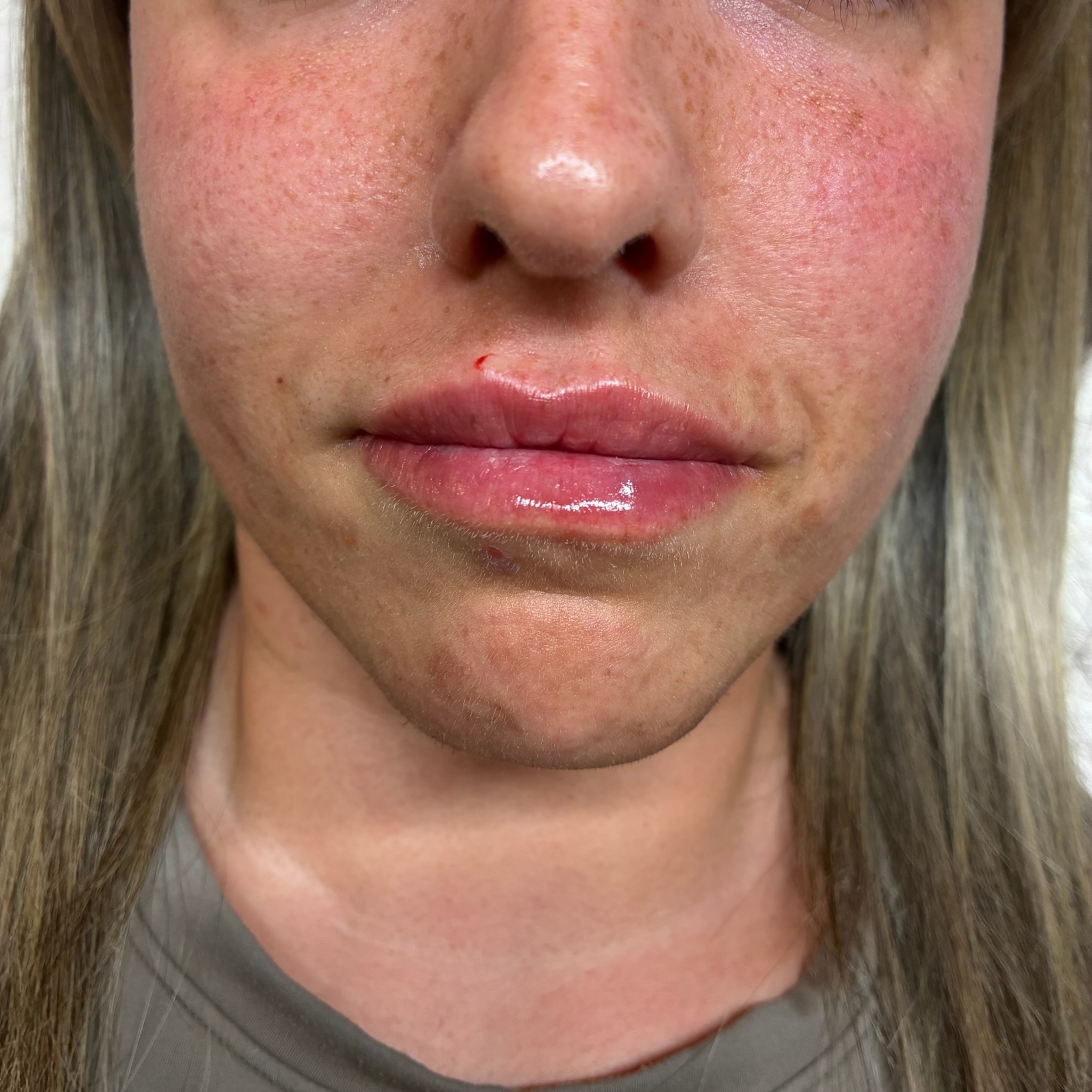 lips four front after