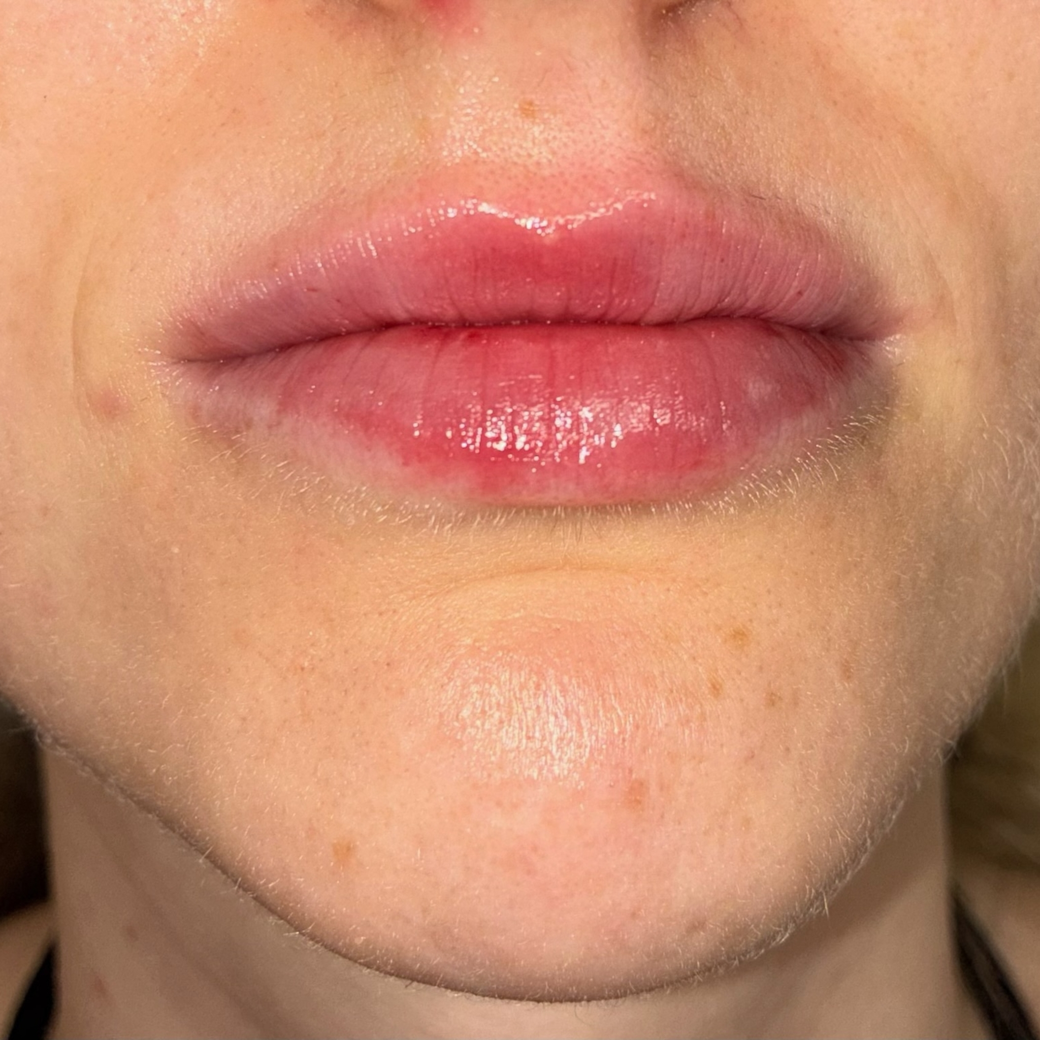 lips nine front after