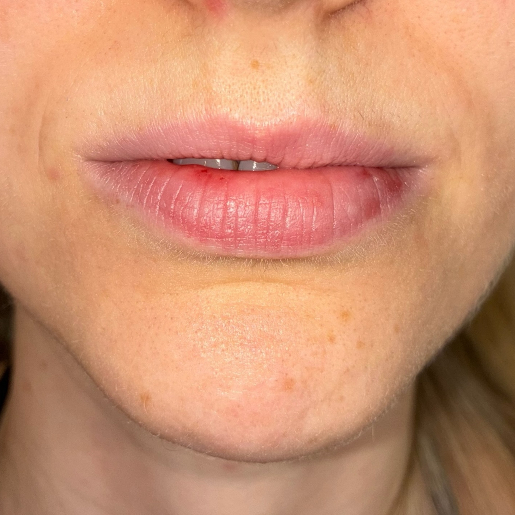 lips nine front before