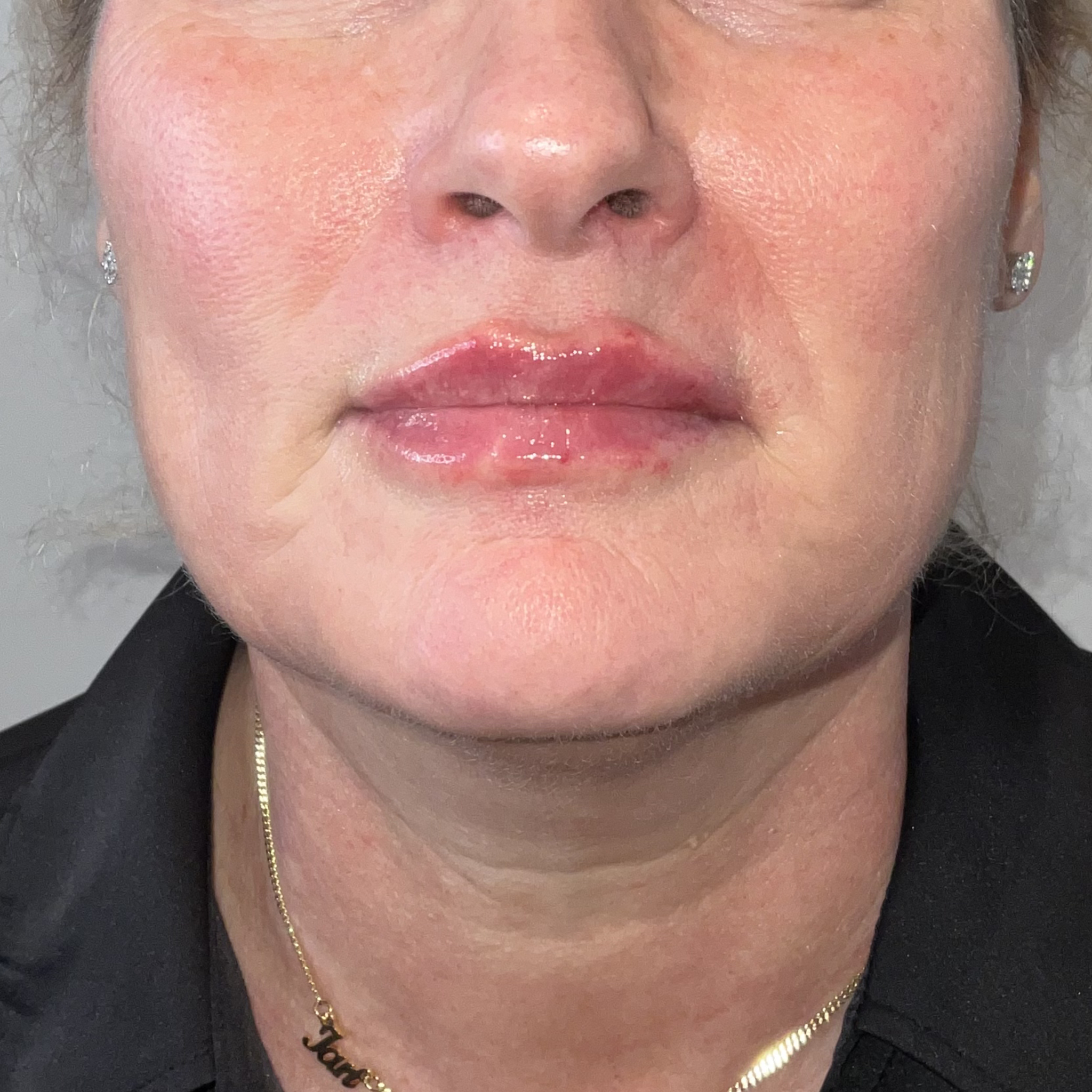 lips one front after
