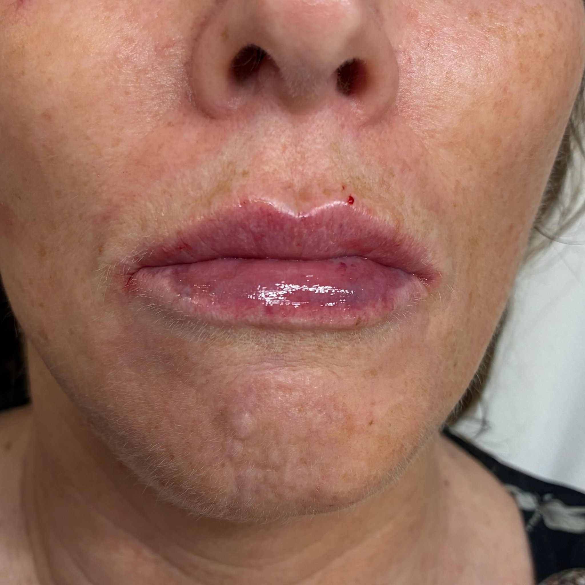 lips seven front after
