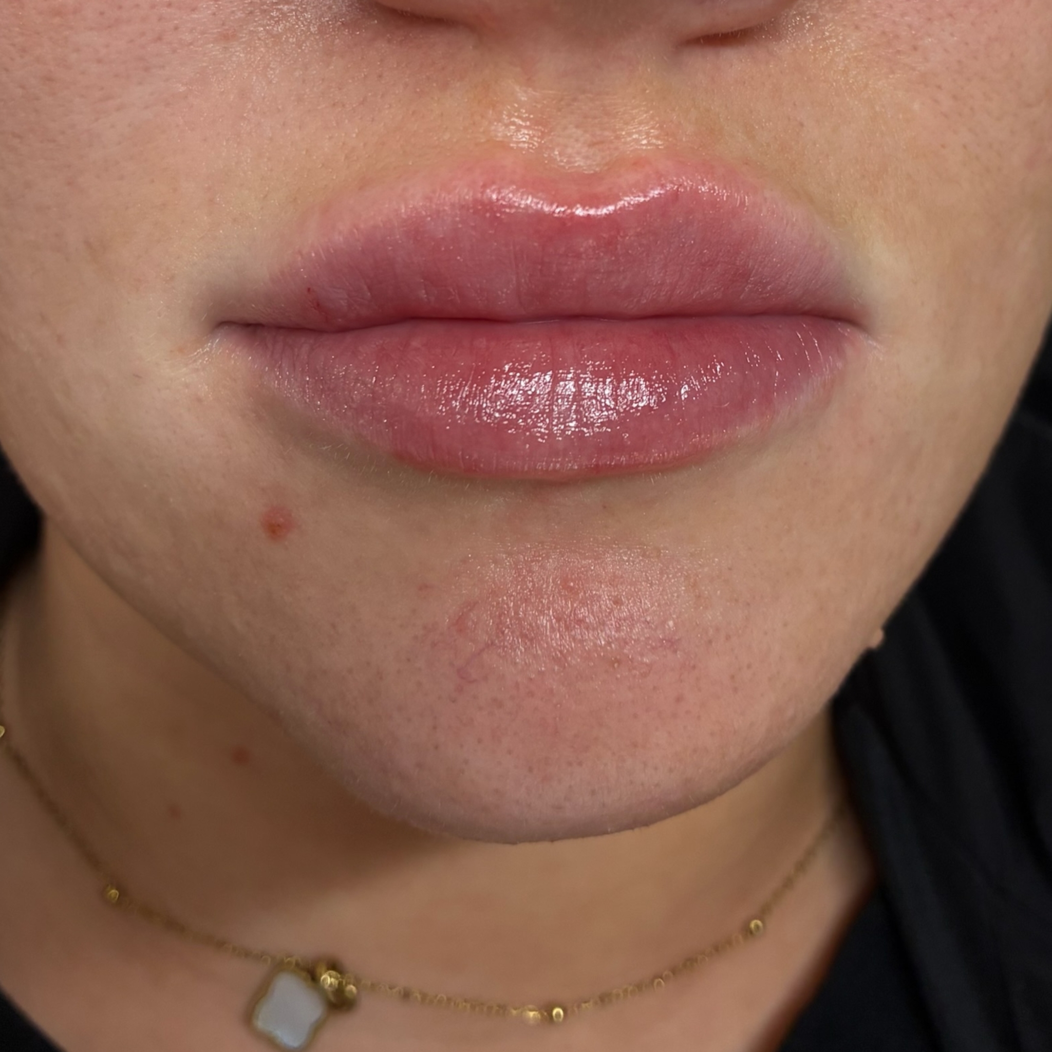 lips six front after