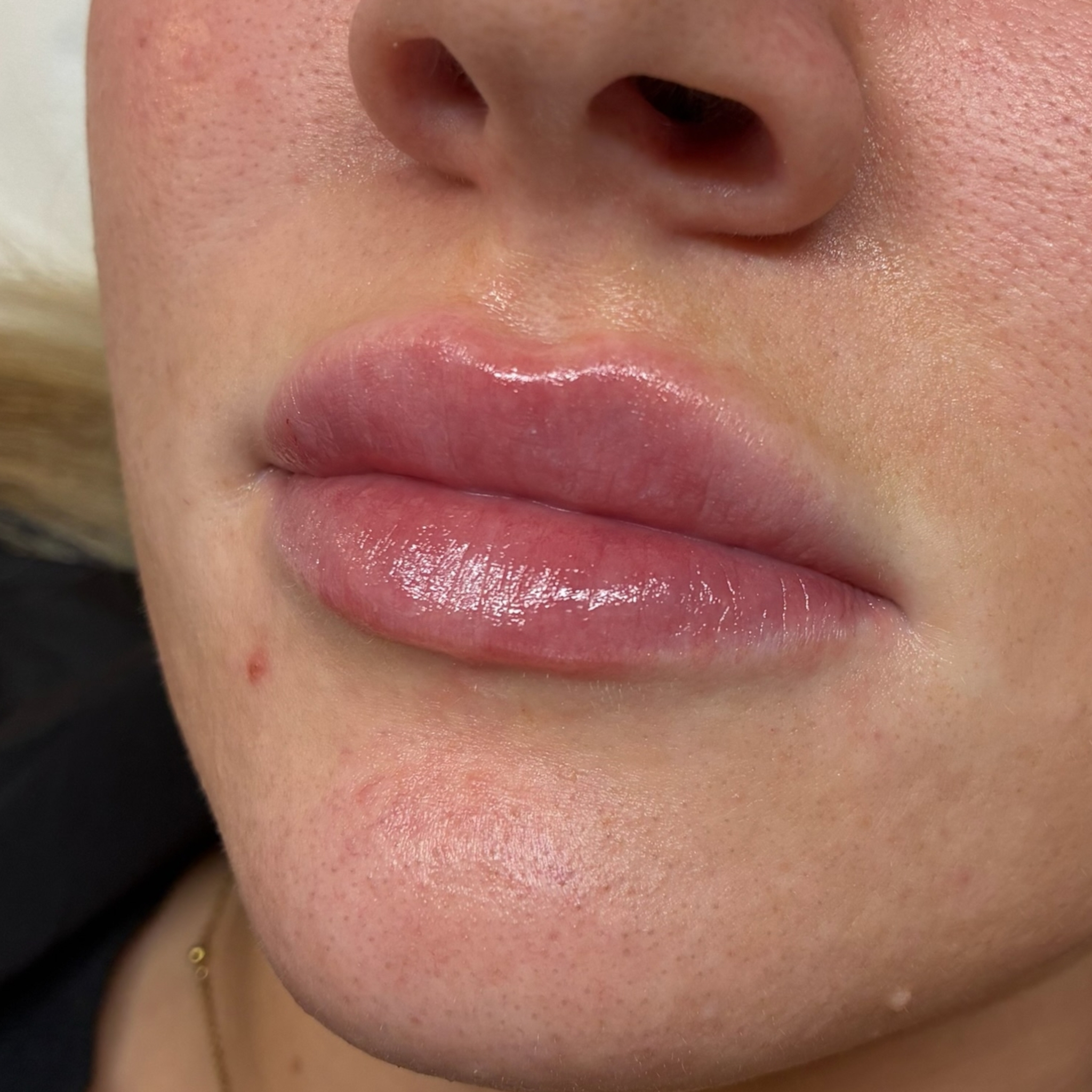 lips six left after