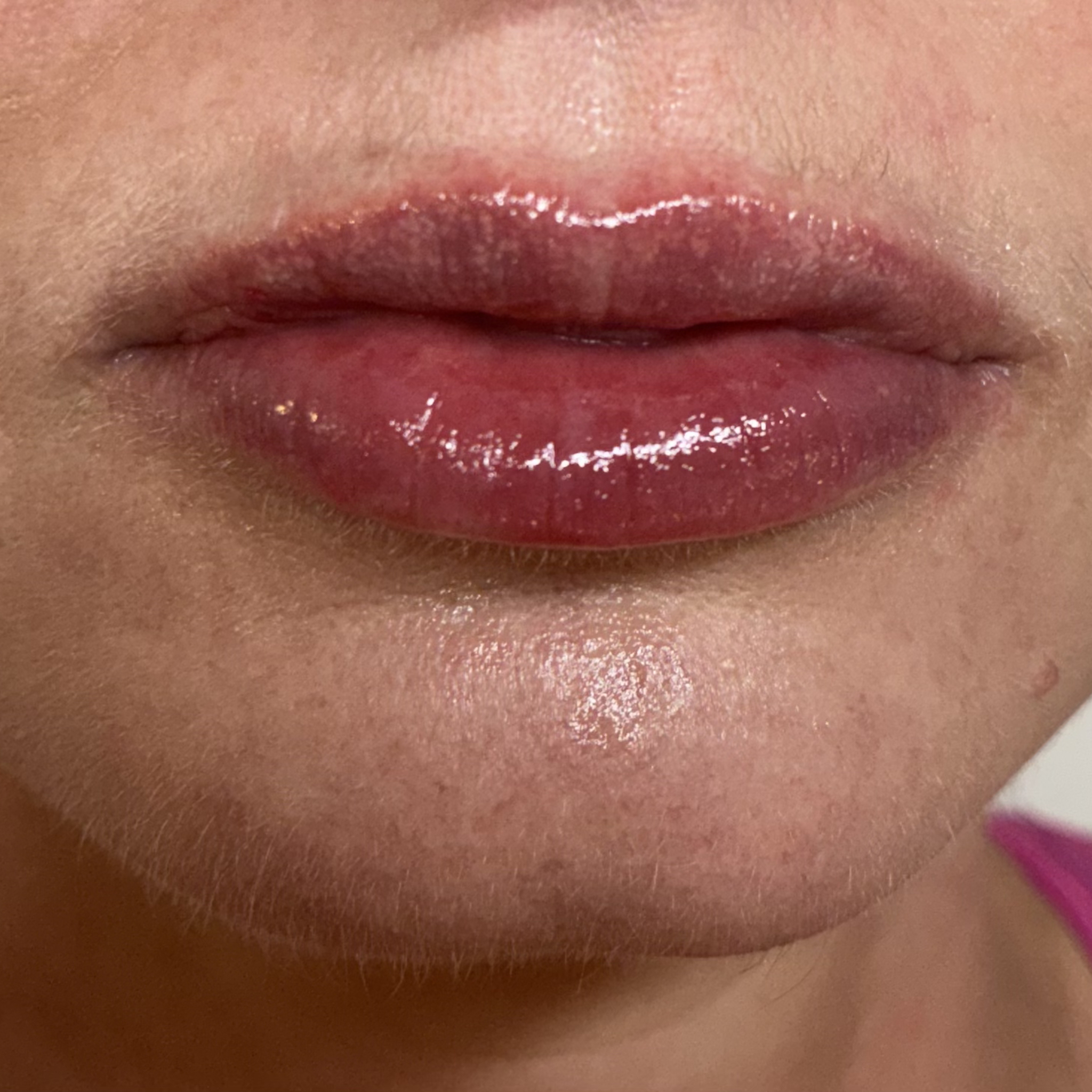 lips ten front after