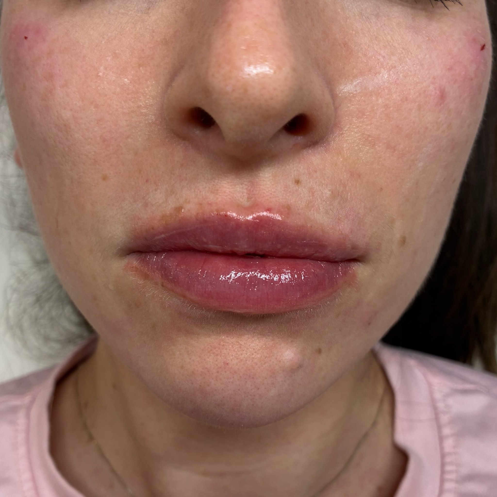lips three front after