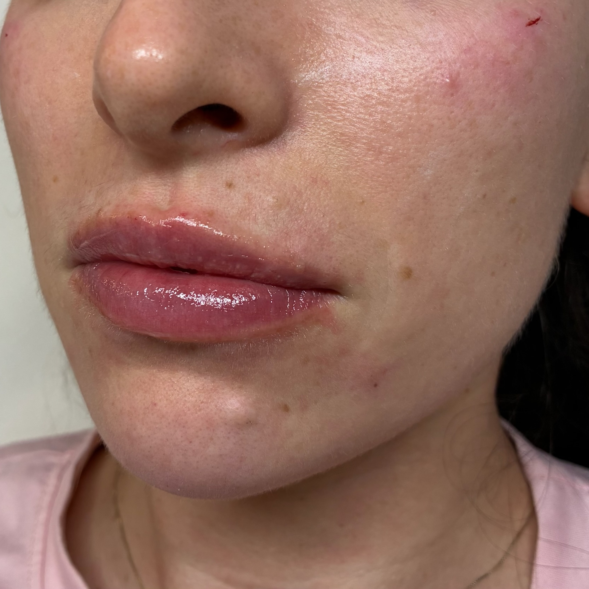 lips three left after
