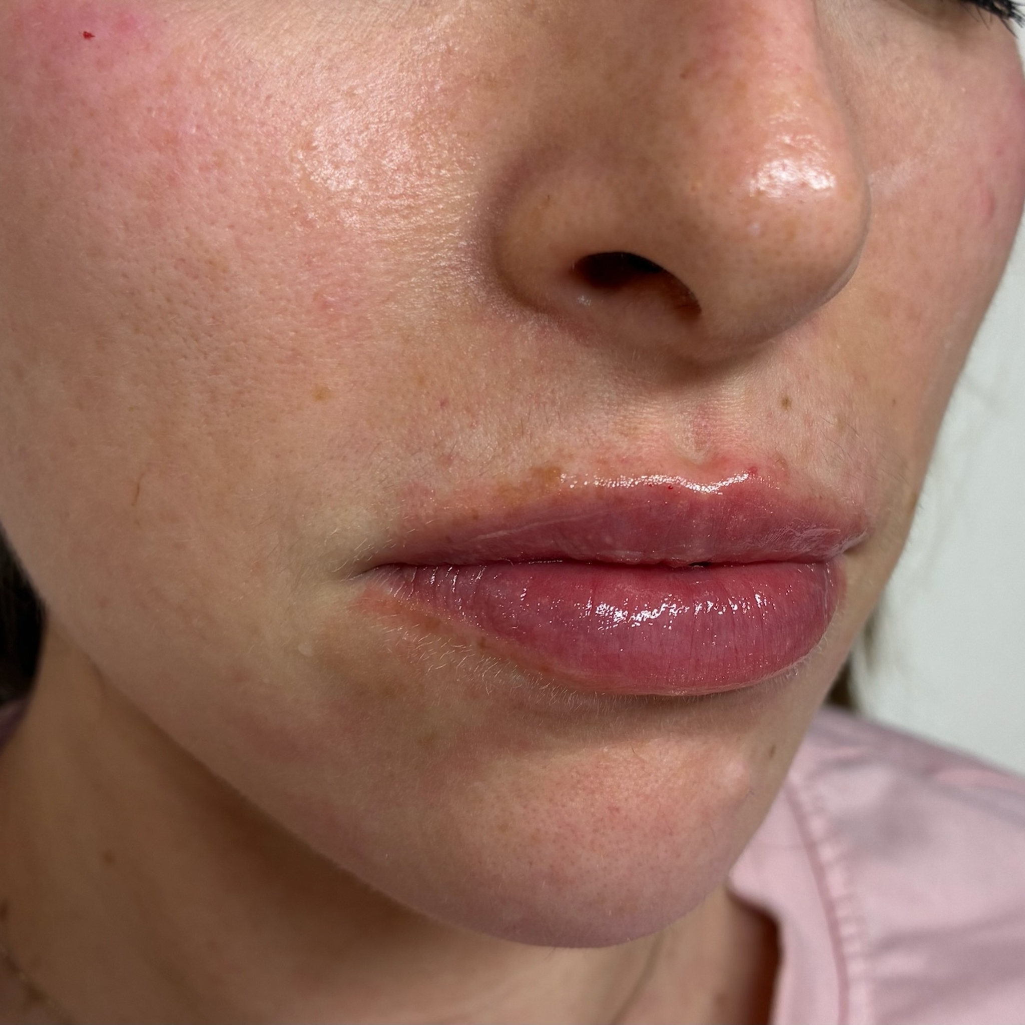 lips three right after