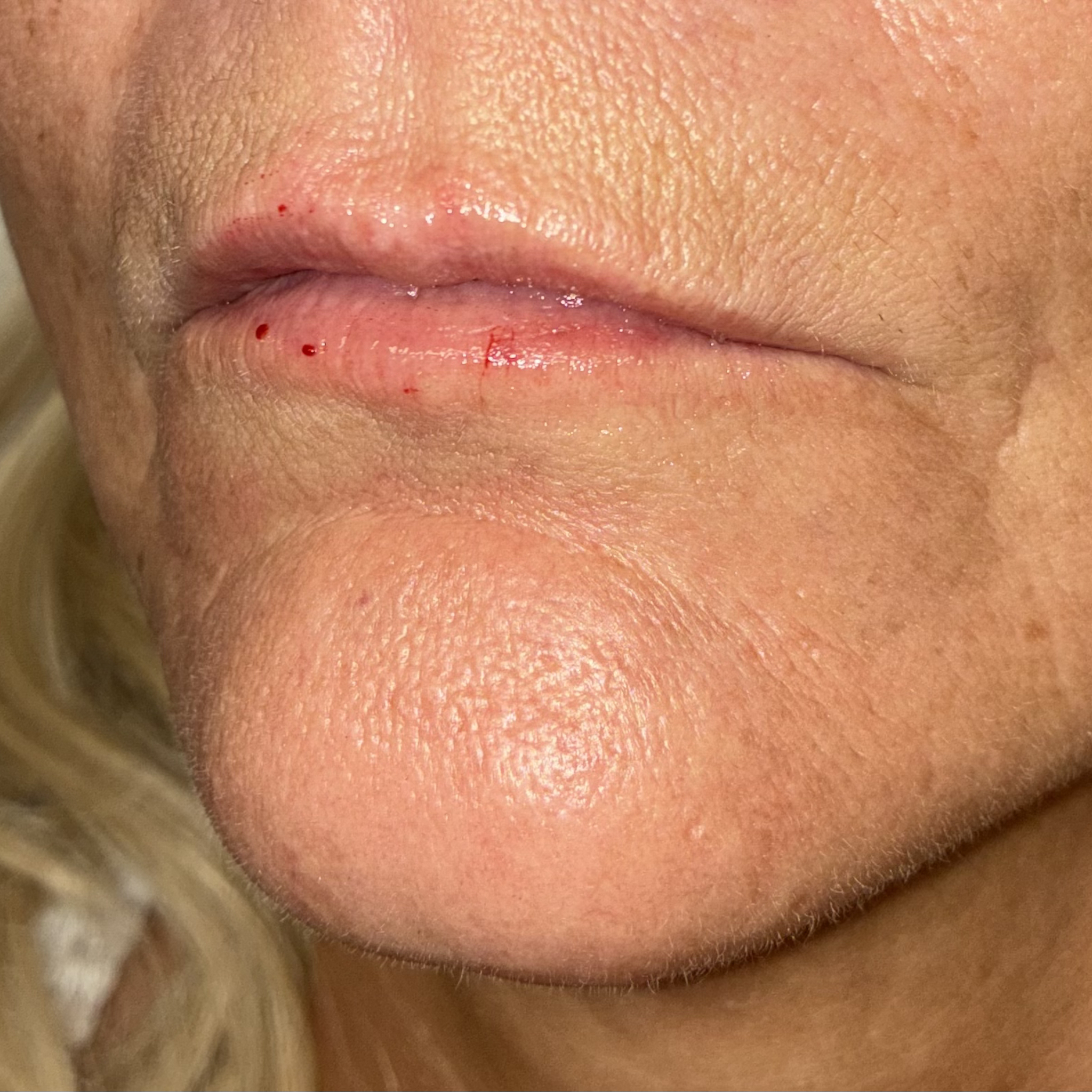 lips twelve left after