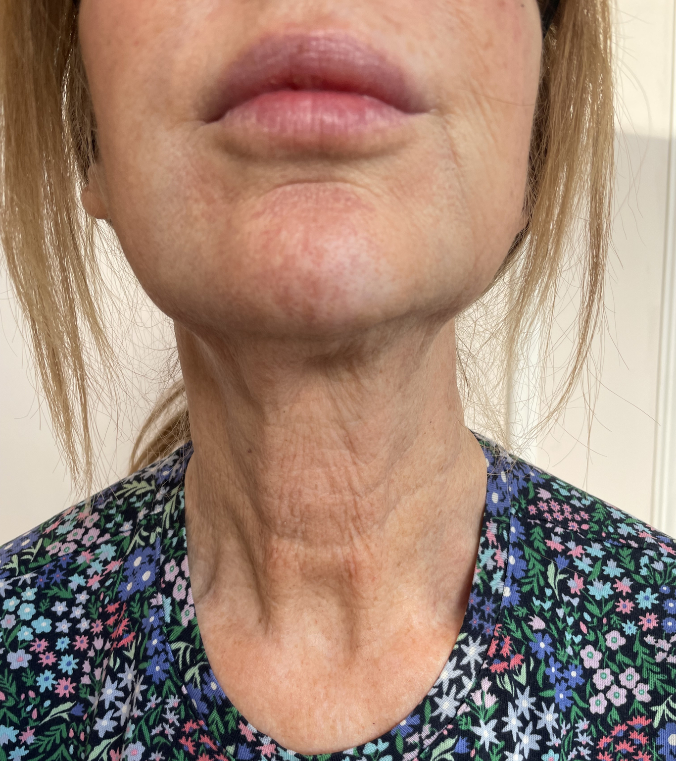 polynucleotides neck before front