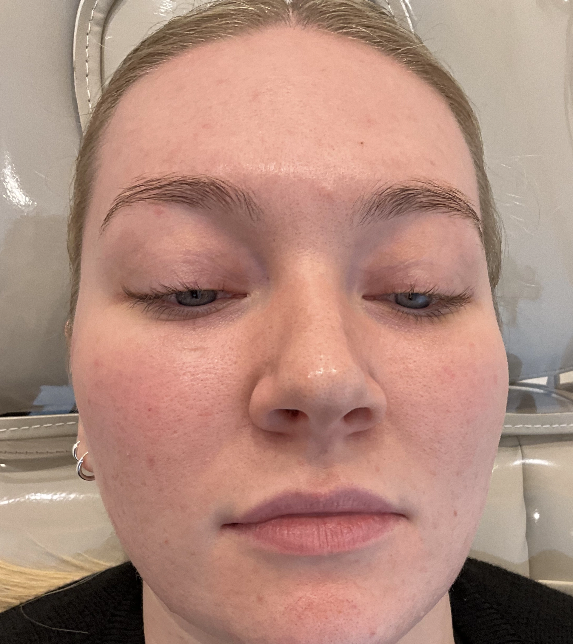 lip filler before front