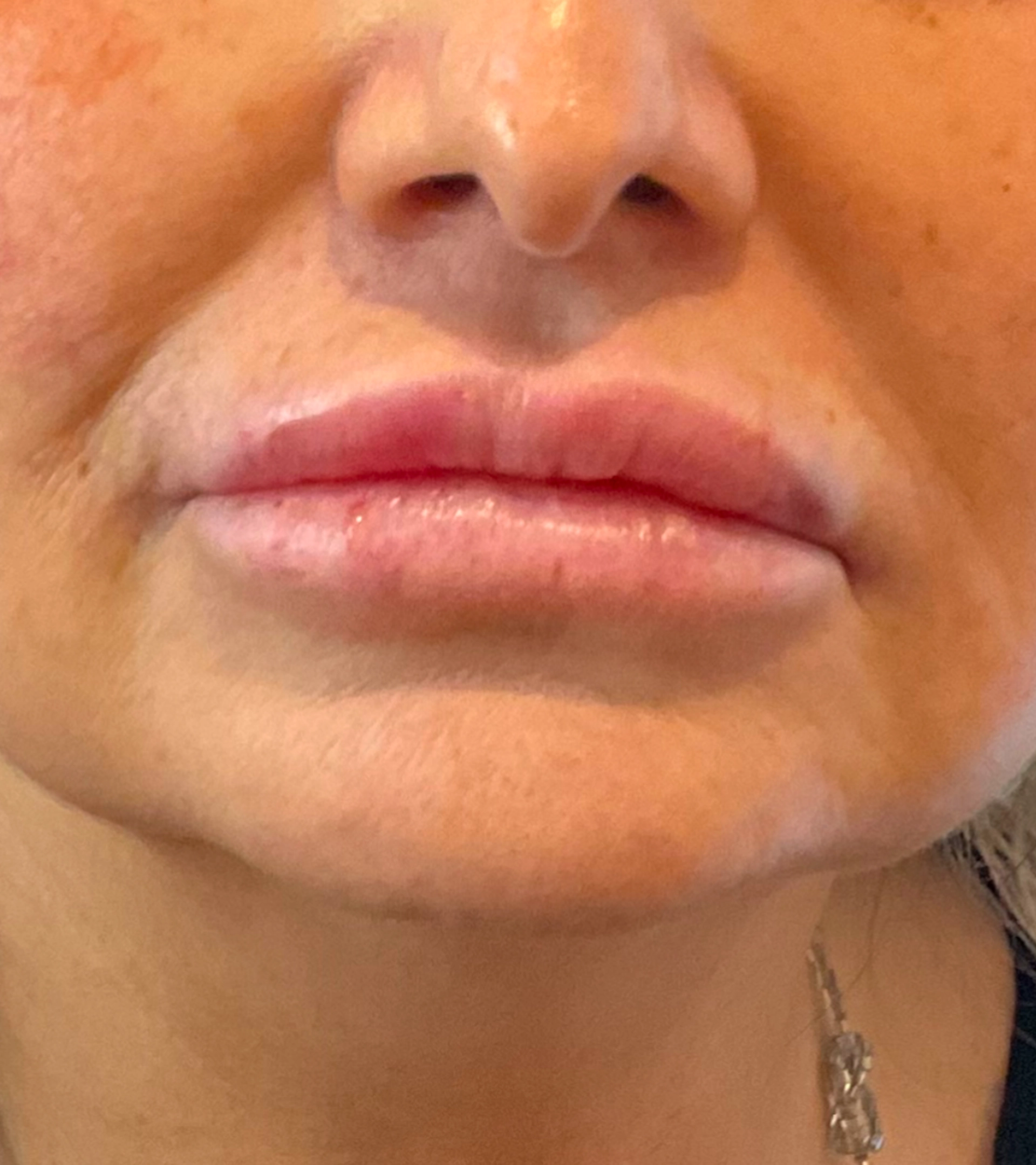 lips before dissolving